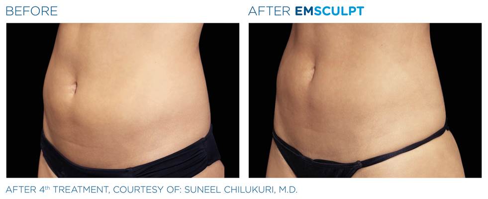 EMSCULPT